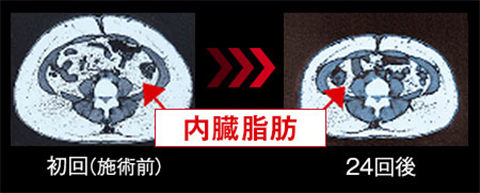 図:施術前~24回後の内臓脂肪量
