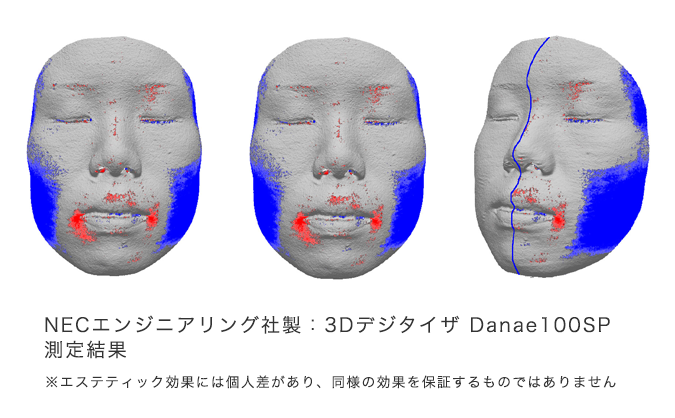 フェイスラインを引き締める！！顔やせ効果