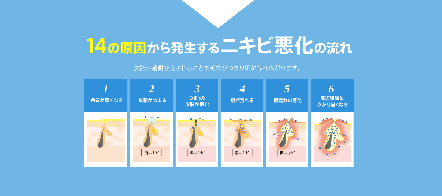 14の原因から発生するニキビ悪化の流れ 皮脂が過剰分泌されることで毛穴が詰まり炎症が発生し広がります。